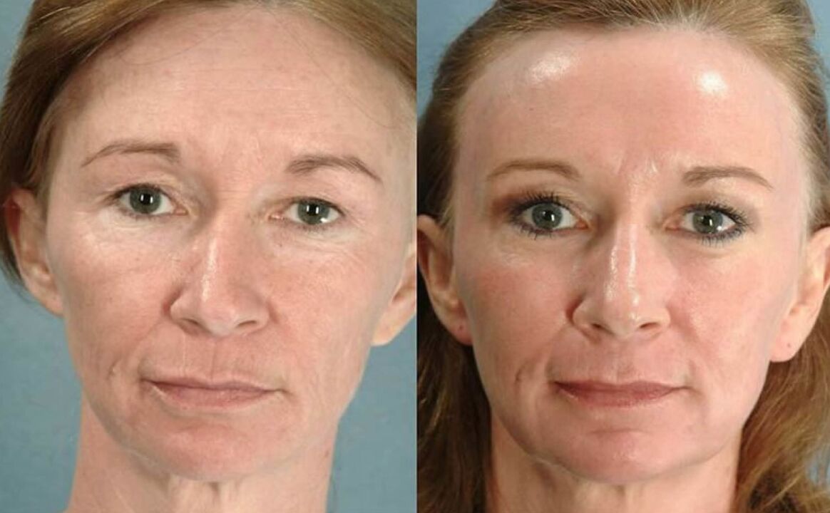 Face before and after fractional rejuvenation