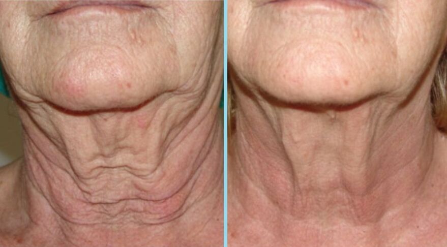 Neck before and after fractional taper