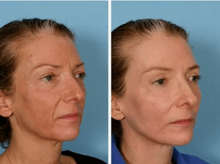 Laser rejuvenation before and after