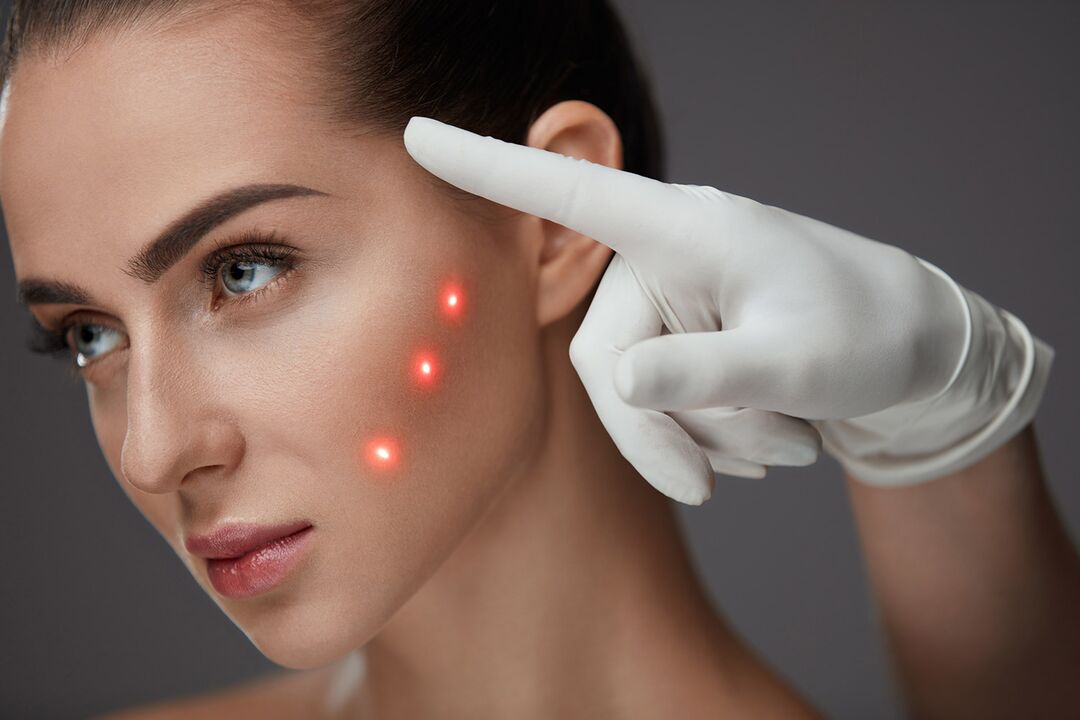 Laser Skin Rejuvenation